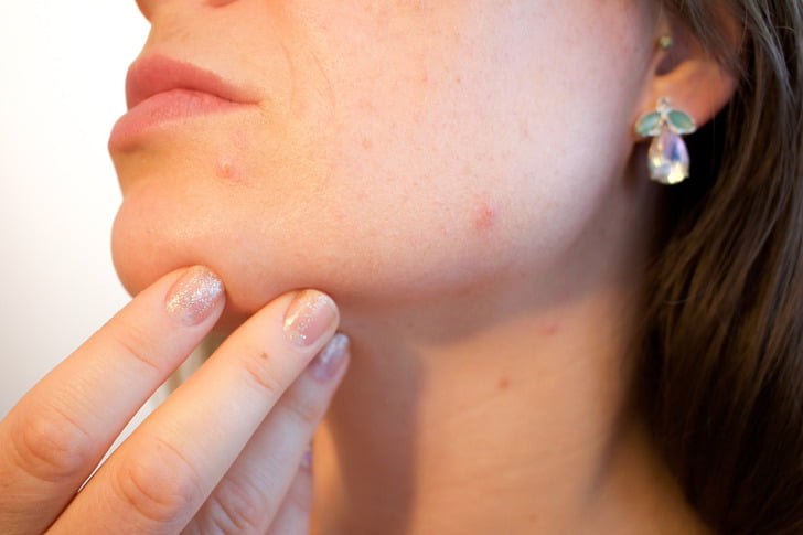 Why Acne Appears on These 8 Body Areas, and What You Should Do