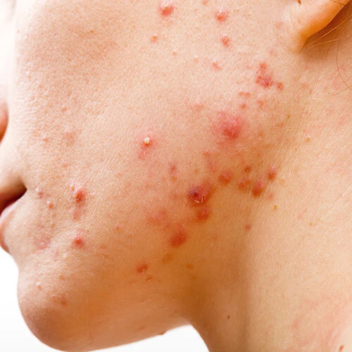 Nodular Acne: Causes, Treatment, Home Remedies & More