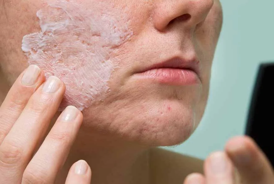 Nodular Acne: Causes, Treatment, Home Remedies & More