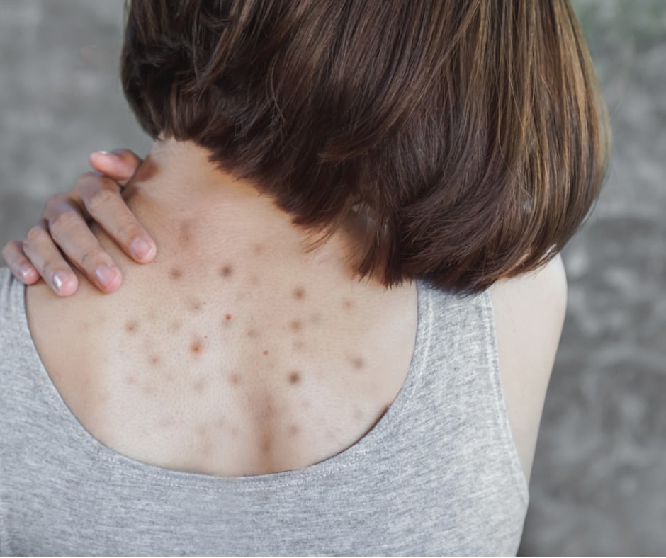 Why Acne Appears on These 8 Body Areas, and What You Should Do