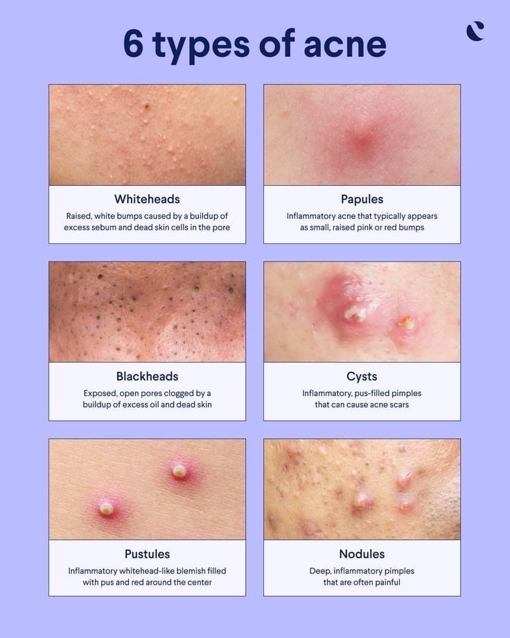 Types of acne: From clogged pores to cysts - factfable