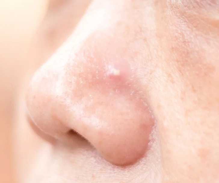 What the Acne on 8 Body Parts Is Trying to Tell You About Your Lifestyle Habits