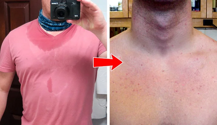 What the Acne on 8 Body Parts Is Trying to Tell You About Your Lifestyle Habits