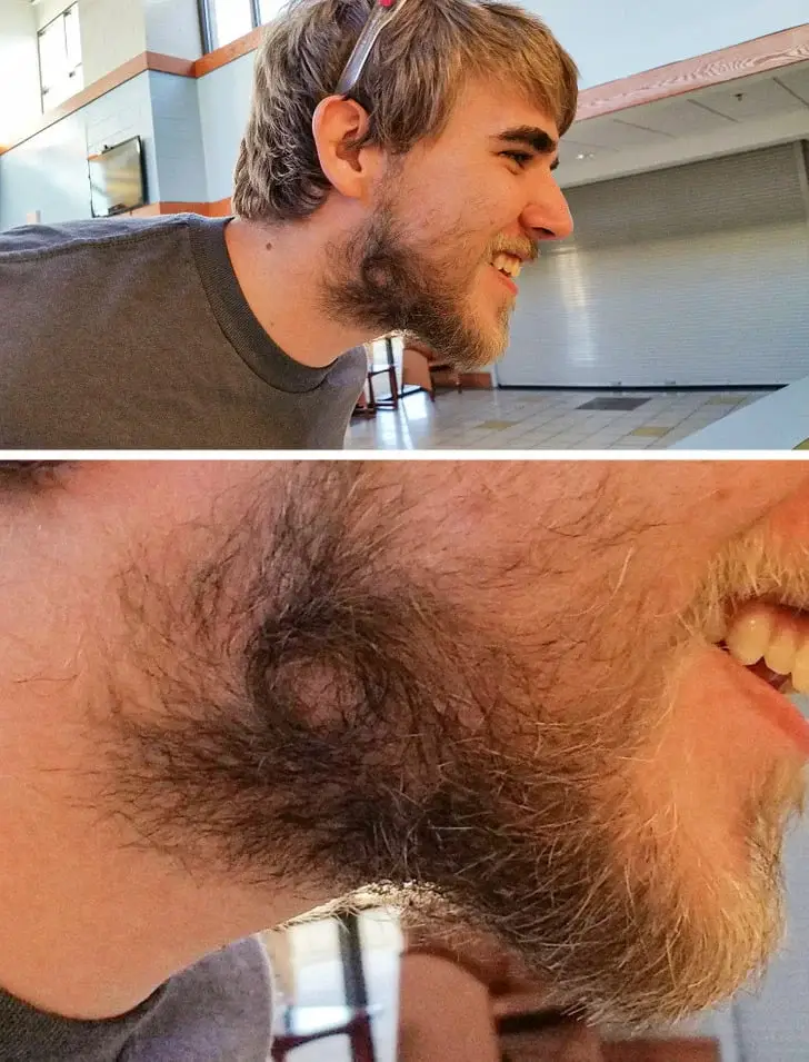 Beard growing in a circle