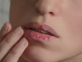 Cold sores herpes simplex